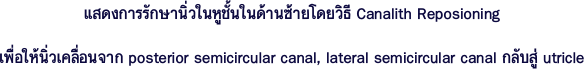 แสดงการรักษานิ่วในหูชั้นในด้านซ้ายโดยวิธี Canalith Reposioning 
เพื่อให้นิ่วเคลื่อนจาก posterior semicircular canal, lateral semicircular canal กลับสู่ utricle